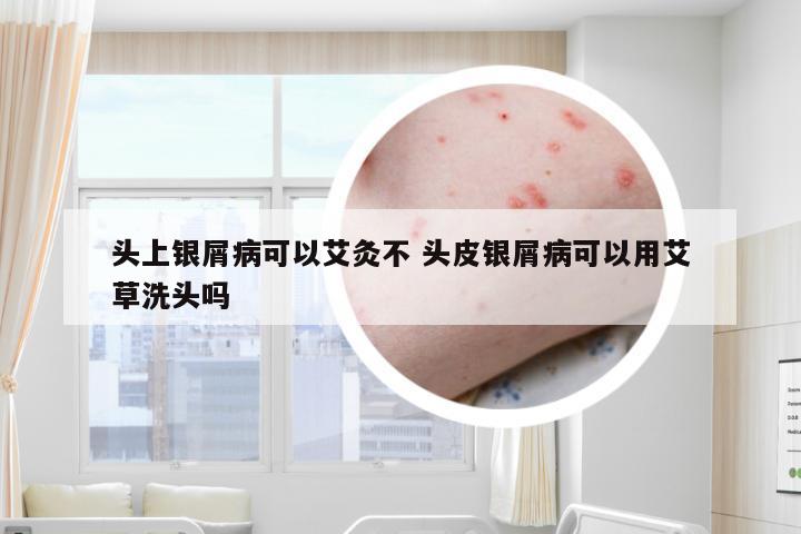 头上银屑病可以艾灸不 头皮银屑病可以用艾草洗头吗