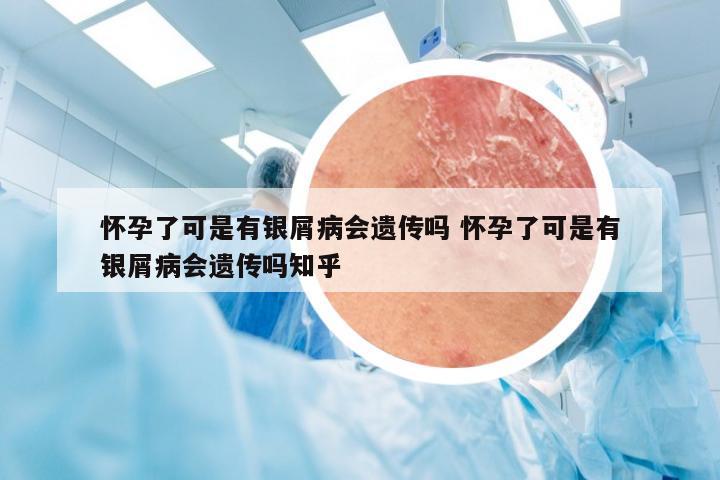 怀孕了可是有银屑病会遗传吗 怀孕了可是有银屑病会遗传吗知乎