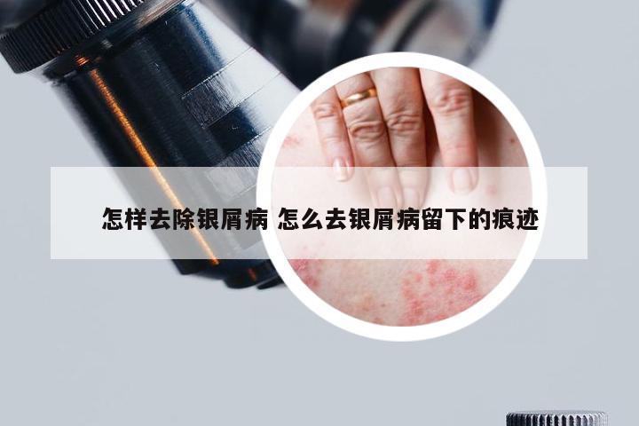 怎样去除银屑病 怎么去银屑病留下的痕迹