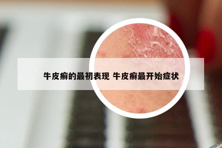 牛皮癣的最初表现 牛皮癣最开始症状
