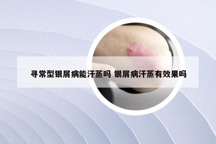 寻常型银屑病能汗蒸吗 银屑病汗蒸有效果吗