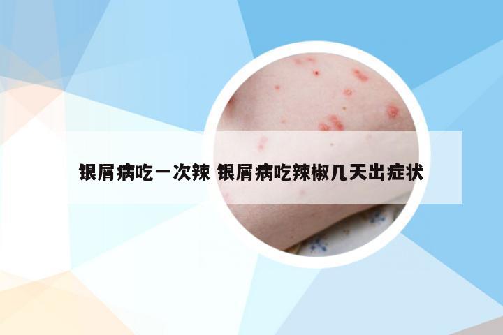 银屑病吃一次辣 银屑病吃辣椒几天出症状