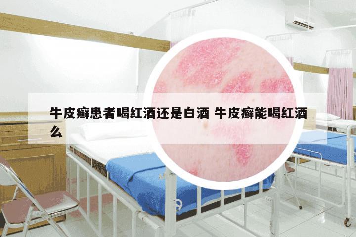 牛皮癣患者喝红酒还是白酒 牛皮癣能喝红酒么