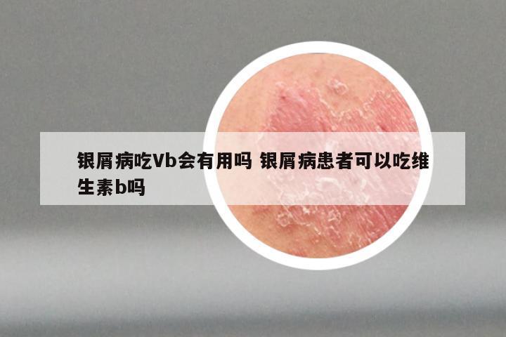 银屑病吃Vb会有用吗 银屑病患者可以吃维生素b吗