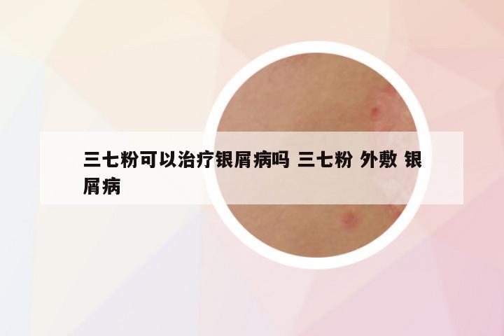 三七粉可以治疗银屑病吗 三七粉 外敷 银屑病