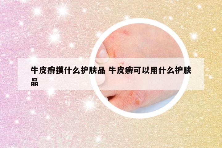 牛皮癣摸什么护肤品 牛皮癣可以用什么护肤品