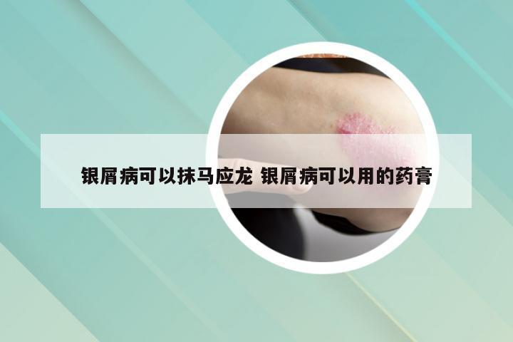 银屑病可以抹马应龙 银屑病可以用的药膏