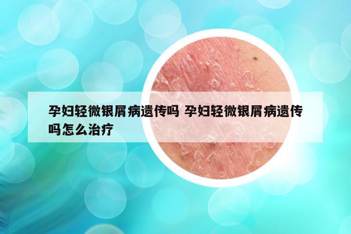 孕妇轻微银屑病遗传吗 孕妇轻微银屑病遗传吗怎么治疗