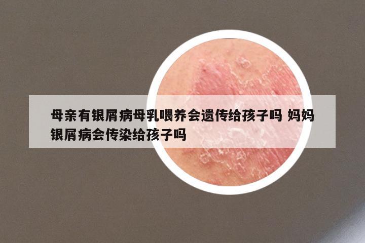 母亲有银屑病母乳喂养会遗传给孩子吗 妈妈银屑病会传染给孩子吗