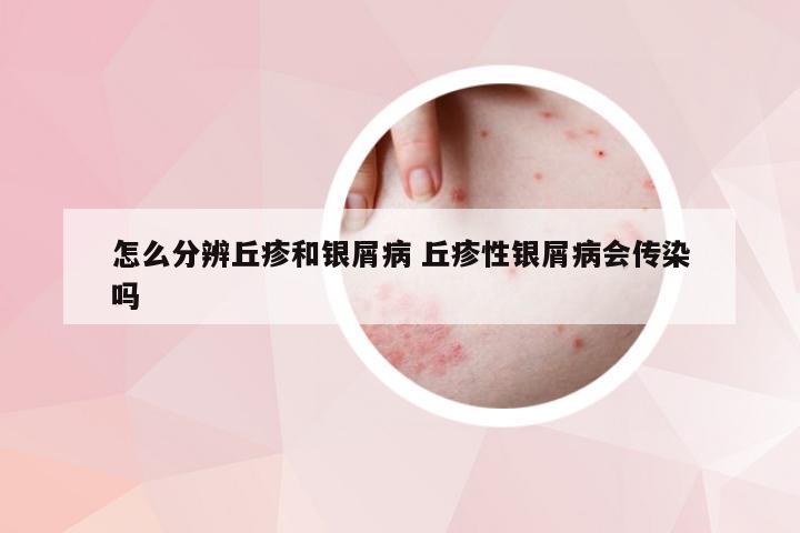 怎么分辨丘疹和银屑病 丘疹性银屑病会传染吗