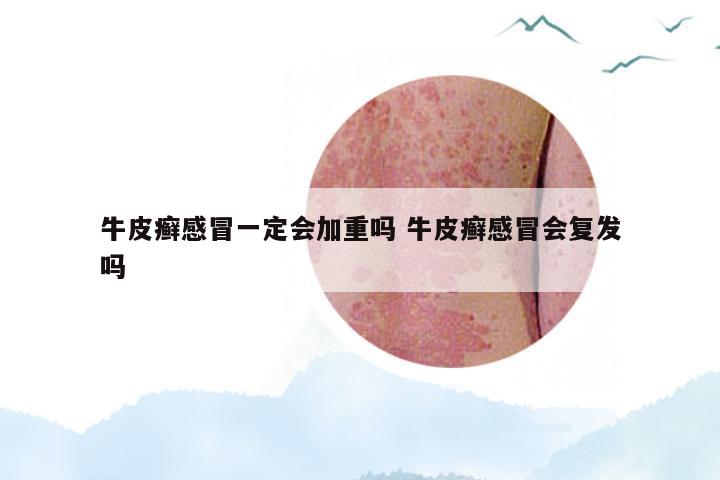 牛皮癣感冒一定会加重吗 牛皮癣感冒会复发吗