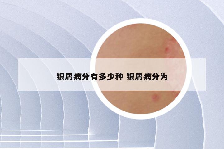 银屑病分有多少种 银屑病分为
