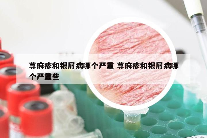 荨麻疹和银屑病哪个严重 荨麻疹和银屑病哪个严重些