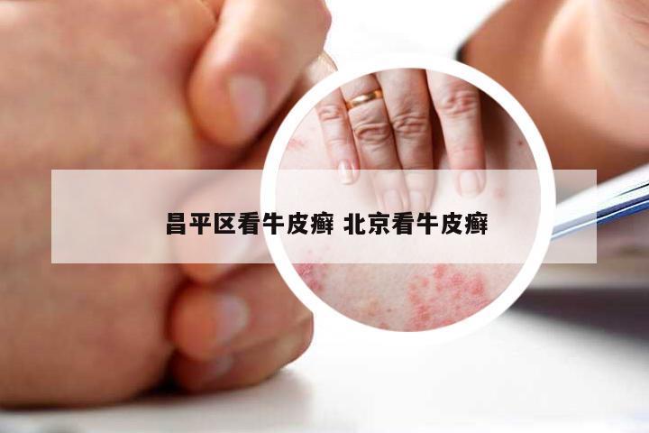 昌平区看牛皮癣 北京看牛皮癣