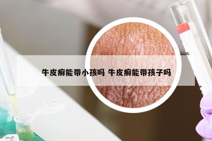 牛皮癣能带小孩吗 牛皮癣能带孩子吗