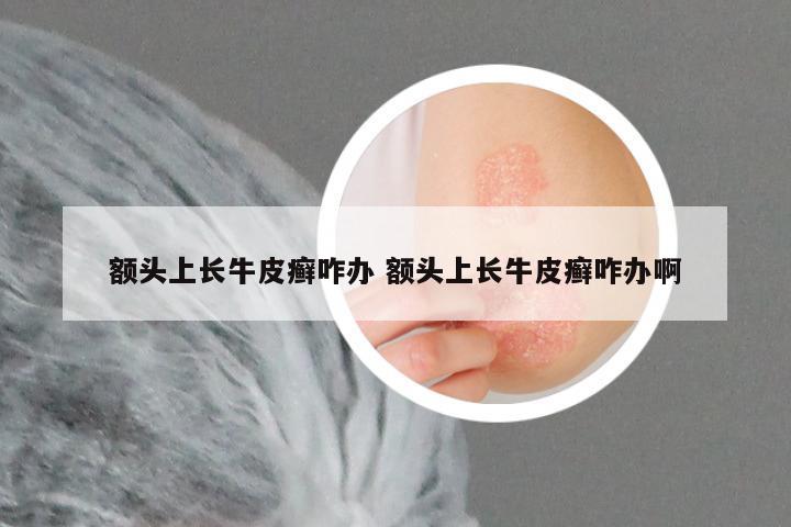 额头上长牛皮癣咋办 额头上长牛皮癣咋办啊
