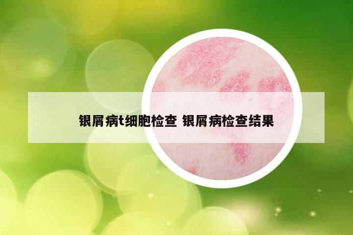 银屑病t细胞检查 银屑病检查结果