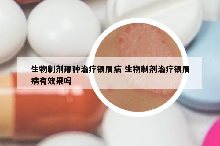 生物制剂那种治疗银屑病 生物制剂治疗银屑病有效果吗