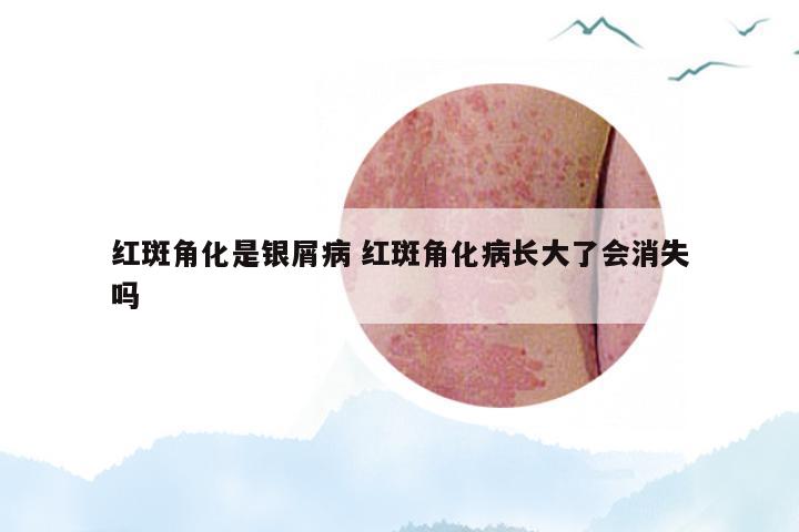 红斑角化是银屑病 红斑角化病长大了会消失吗
