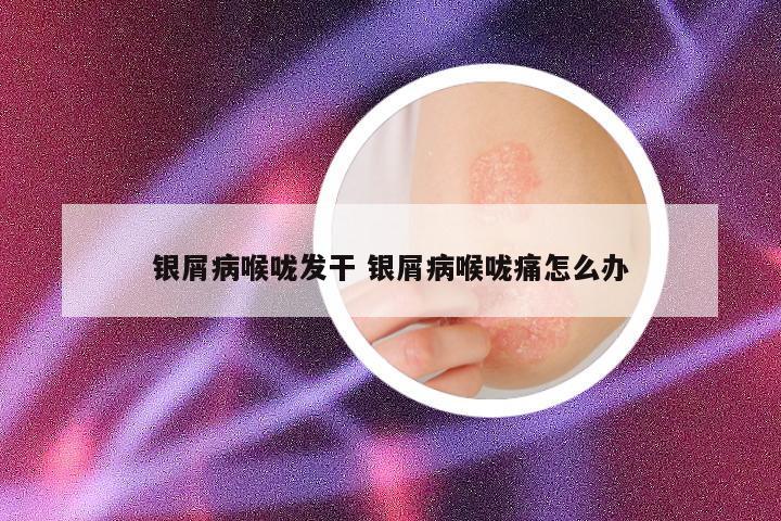 银屑病喉咙发干 银屑病喉咙痛怎么办