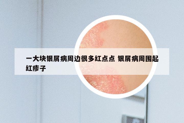 一大块银屑病周边很多红点点 银屑病周围起红疹子