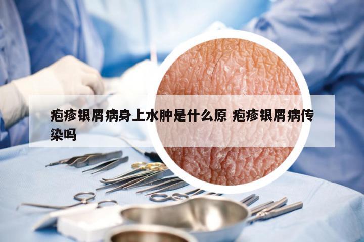 疱疹银屑病身上水肿是什么原 疱疹银屑病传染吗
