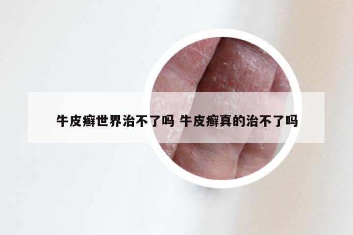 牛皮癣世界治不了吗 牛皮癣真的治不了吗