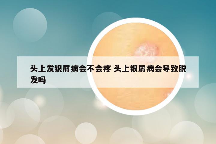 头上发银屑病会不会疼 头上银屑病会导致脱发吗
