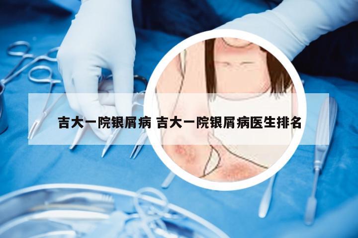 吉大一院银屑病 吉大一院银屑病医生排名
