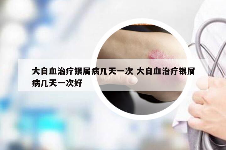 大自血治疗银屑病几天一次 大自血治疗银屑病几天一次好