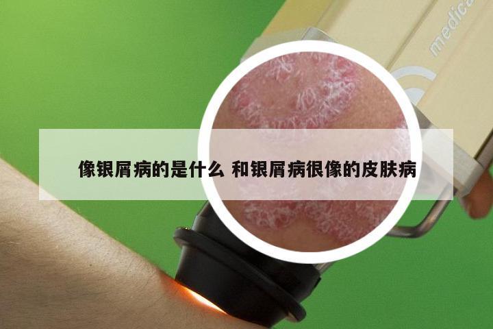 像银屑病的是什么 和银屑病很像的皮肤病