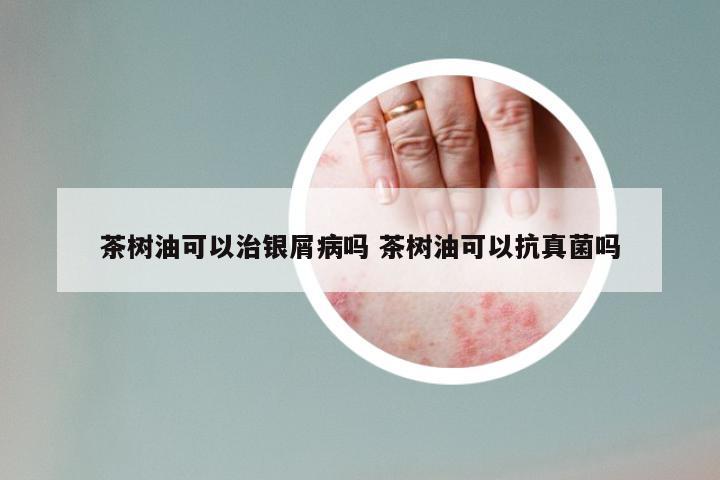茶树油可以治银屑病吗 茶树油可以抗真菌吗