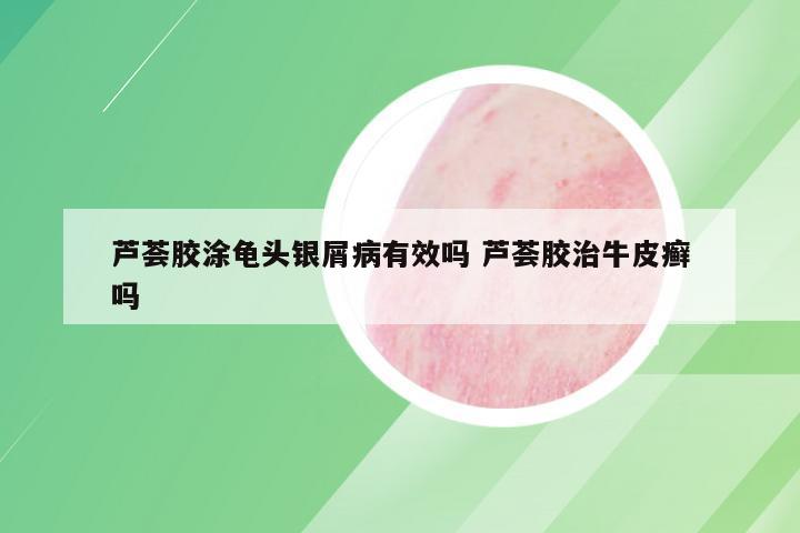 芦荟胶涂龟头银屑病有效吗 芦荟胶治牛皮癣吗