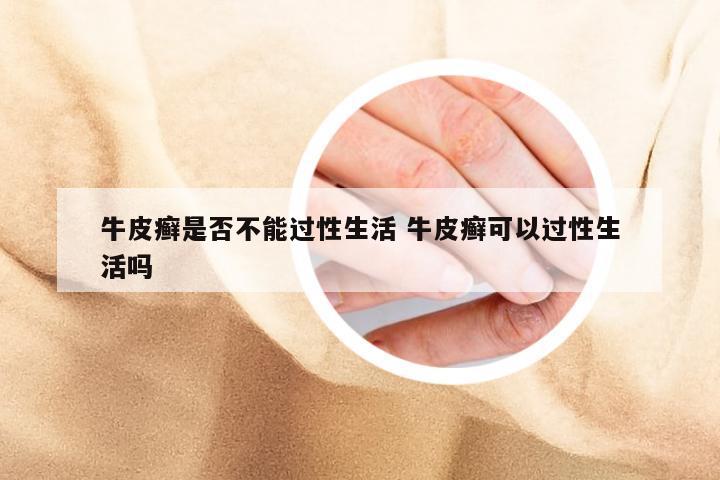 牛皮癣是否不能过性生活 牛皮癣可以过性生活吗