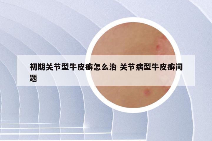 初期关节型牛皮癣怎么治 关节病型牛皮癣问题