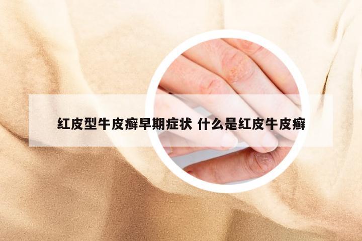 红皮型牛皮癣早期症状 什么是红皮牛皮癣