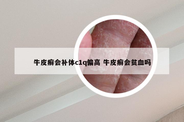 牛皮癣会补体c1q偏高 牛皮癣会贫血吗