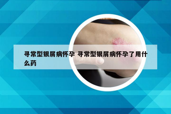 寻常型银屑病怀孕 寻常型银屑病怀孕了用什么药