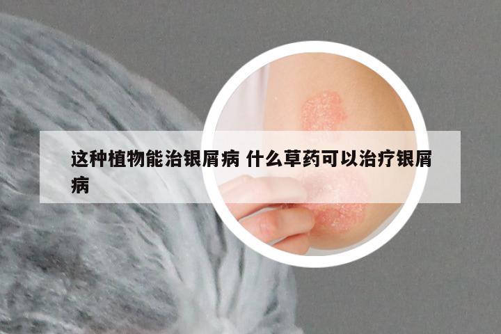这种植物能治银屑病 什么草药可以治疗银屑病