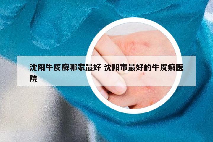 沈阳牛皮癣哪家最好 沈阳市最好的牛皮癣医院