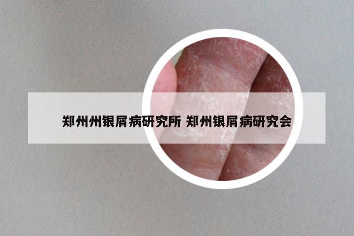 郑州州银屑病研究所 郑州银屑病研究会