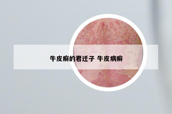 牛皮癣的君迁子 牛皮病癣