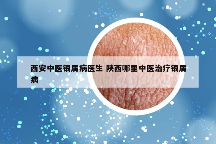西安中医银屑病医生 陕西哪里中医治疗银屑病