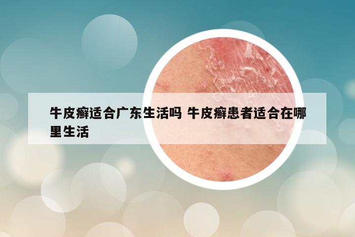 牛皮癣适合广东生活吗 牛皮癣患者适合在哪里生活