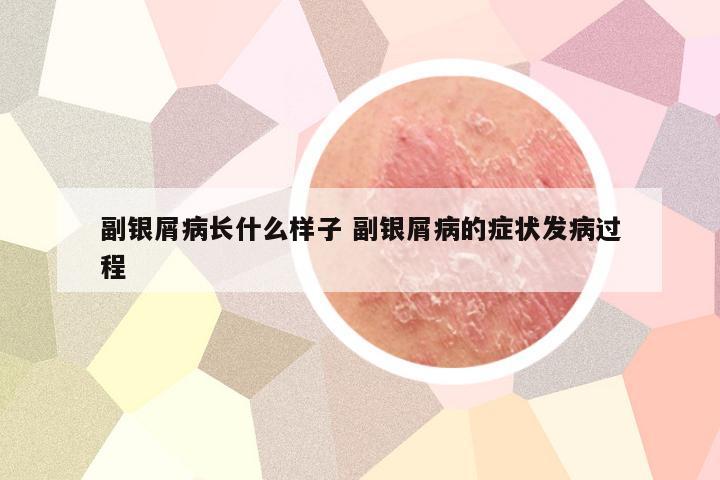 副银屑病长什么样子 副银屑病的症状发病过程