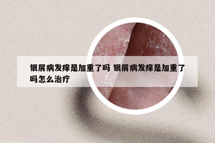 银屑病发痒是加重了吗 银屑病发痒是加重了吗怎么治疗
