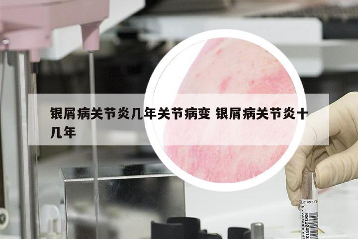 银屑病关节炎几年关节病变 银屑病关节炎十几年