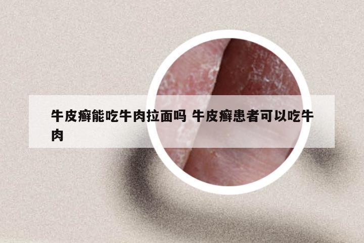 牛皮癣能吃牛肉拉面吗 牛皮癣患者可以吃牛肉