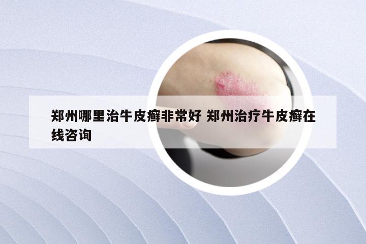 郑州哪里治牛皮癣非常好 郑州治疗牛皮癣在线咨询