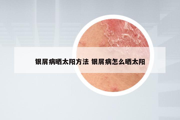 银屑病晒太阳方法 银屑病怎么晒太阳